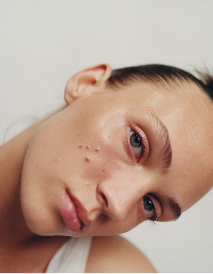 Hinh anh Vì sao liệu trình trị mụn của bạn không thật sự hiệu quả?  1